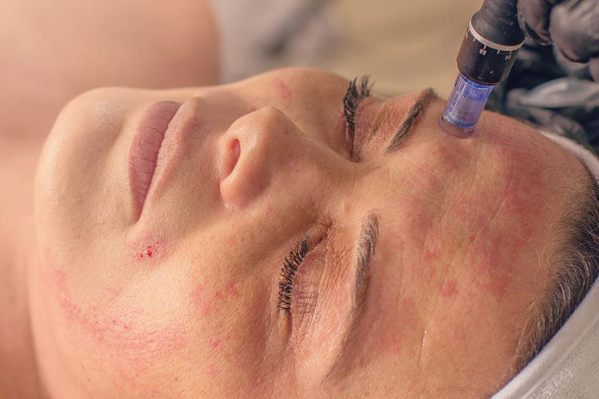 Microneedling-Ayur Aesthetics,Missouri,City