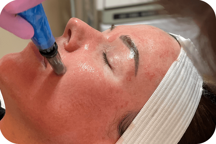 Microneedling-Ayur Aesthetics,Missouri,City